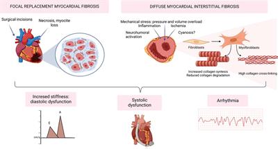 Myocardial fibrosis in congenital heart disease